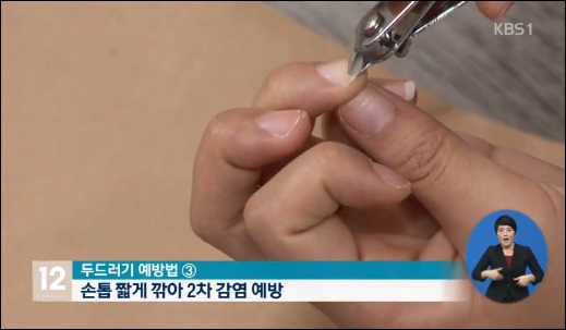 여름철, ‘콜린성 두드러기’ 환자 늘어나. 사진=KBS 뉴스 캡쳐