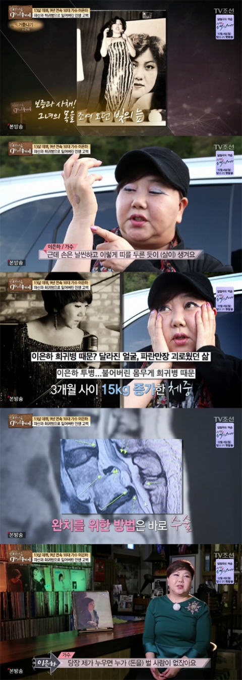 가수 이은하가 앓고 있는 희귀병, ‘쿠싱증후군’이란?