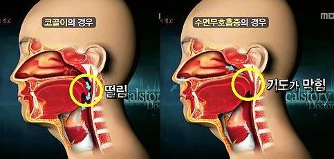 성인 6명 중 1명 ‘폐쇄성 수면무호흡증’···기억상실·우울증 등 유발 사진=MBC화면 캡처