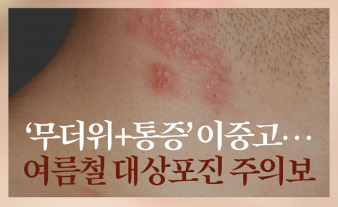 ‘무더위+통증’ 이중고···여름철 대상포진 주의보