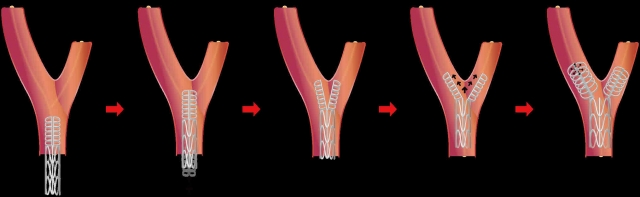 “3D 프린터 활용해 불규칙한 형태의  혈관 삽입 용이한 스텐트 구조 개발”