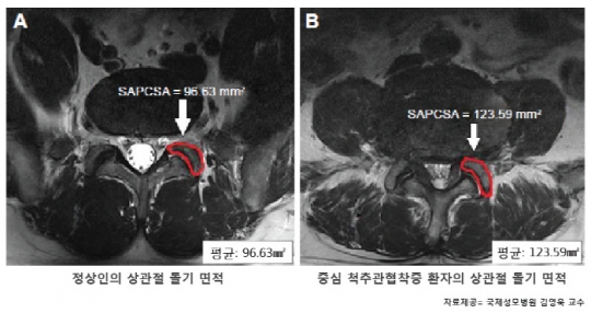 가톨릭관동대 국제성모병원 김영욱 교수, 중심 척추관협착증 원인 새롭게 규명 기사의 사진