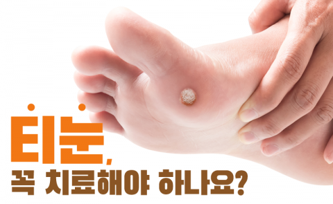 티눈, 꼭 치료해야 하나요?
