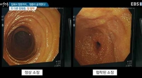 크론병, 염증성 장 질환···육식·유제품·술·커피 피하세요