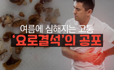 여름에 심해지는 고통···‘요로결석’의 공포
