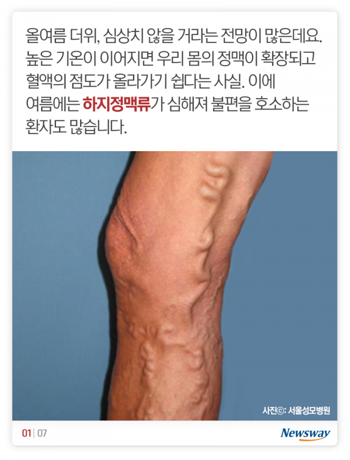 여름에 더 심해진다는 이 혈관질환 기사의 사진