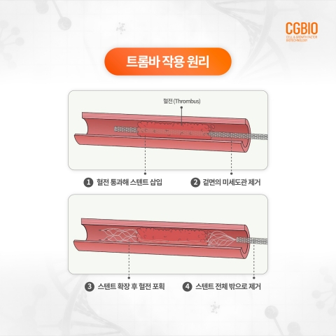 시지바이오, 뇌혈관 스텐트 국산화 성공···'트롬바' 허가