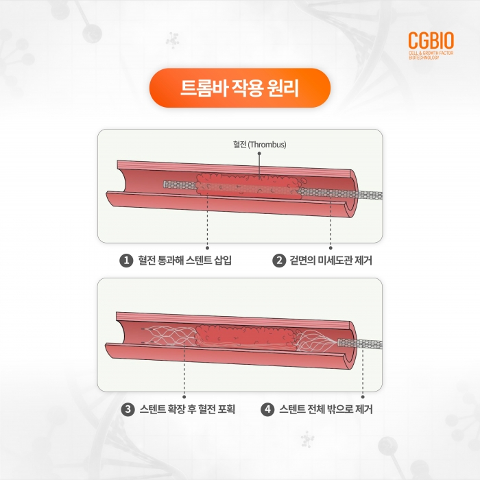 시지바이오, 뇌혈관 스텐트 국산화 성공···'트롬바' 허가 기사의 사진