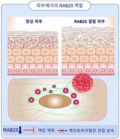 아토피 치료약 개발 실마리 제시···'단백질 RAB25' 연관성 밝혀