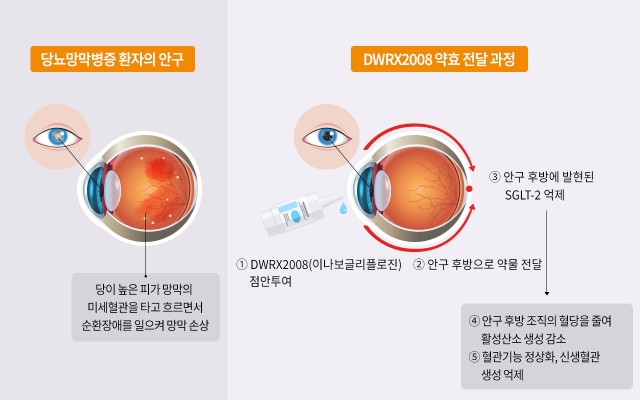 대웅테라퓨틱스, 세계 첫 '점안제형' 당뇨망막병증 치료제 도전