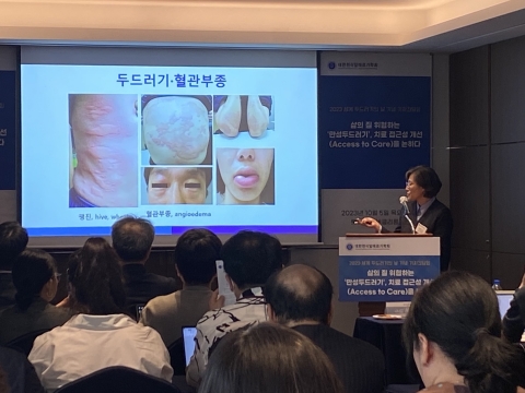 &quot;年 600만원 부담에 권고대로 치료 못 받아&quot;···'만성두드러기', 삶의 질↓