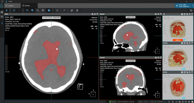 코어라인소프트, AI기반 '뇌 CT 분석 솔루션' 병원 비급여 청구 시작