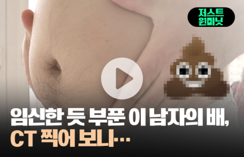 임신한 듯 부푼 이 남자의 배, CT 찍어 보니···