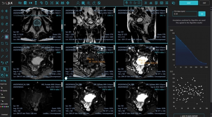 제이엘케이 전립선암 진단 AI 솔루션. JLK 제공