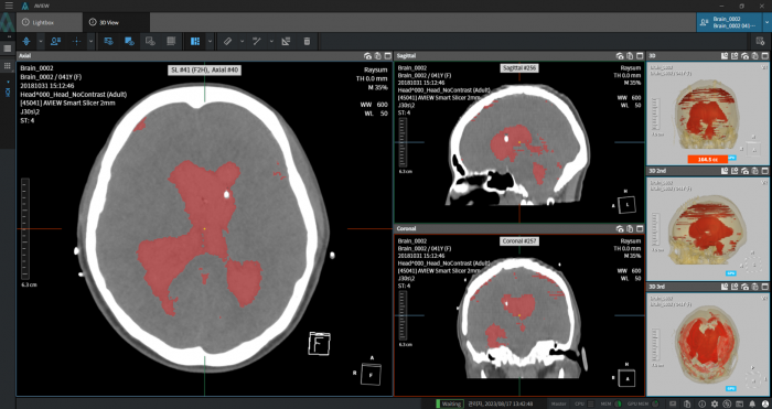 AVIEW Neuro CAD. 코어라인소프트 제공