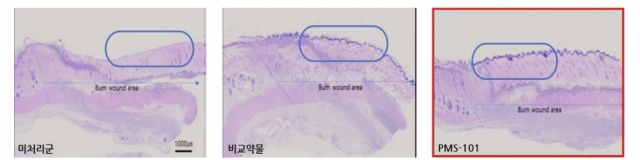 강스템바이오 계열사, '화상치료제' 호주 임상 1/2a상 IND 승인