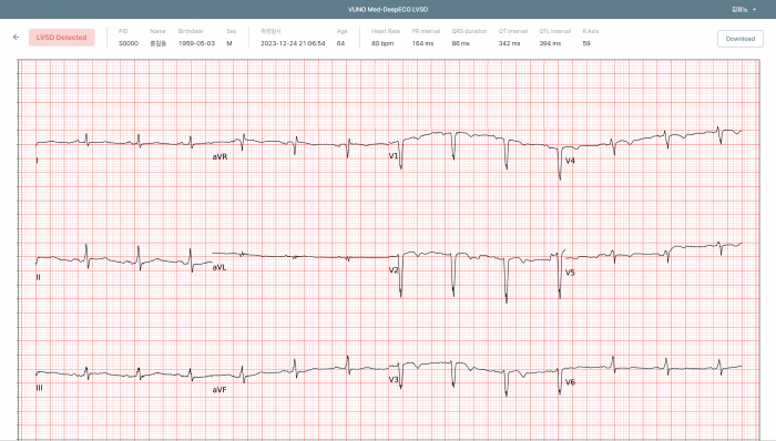 뷰노메드 딥ECG LVSD 운영화면 예시. 사진= 뷰노 제공