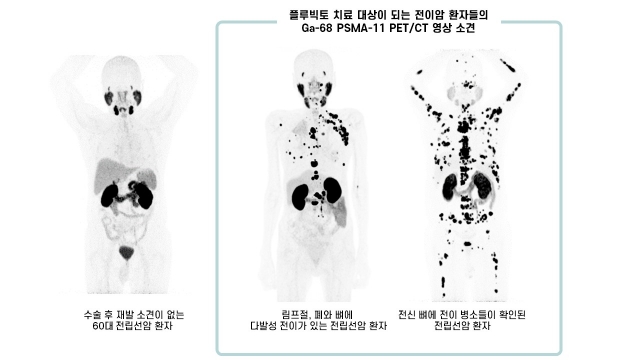 서울아산병원, 암세포만 죽이는 방사성의약품 '플루빅토' 본격 도입