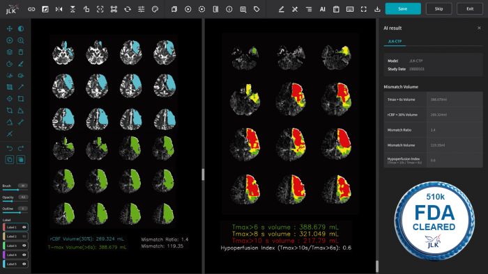 뇌 CT 관류영상 분석 AI 솔루션 JLK-CTP. 사진=제이엘케이 제공
