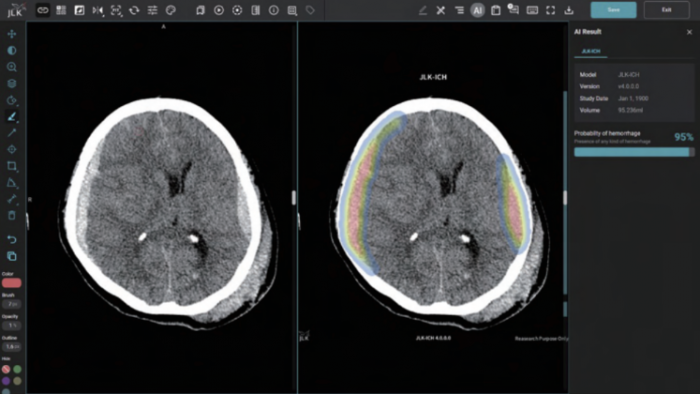 제이엘케이, '두개내출혈 검출 AI 솔루션' 美 FDA 허가