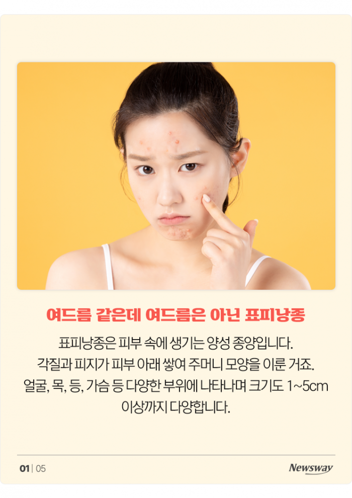 표피낭종, 여드름으로 착각 쉬운 피부 종양···재발·흉터 막으려면 정확한 진단과 치료 중요 기사의 사진