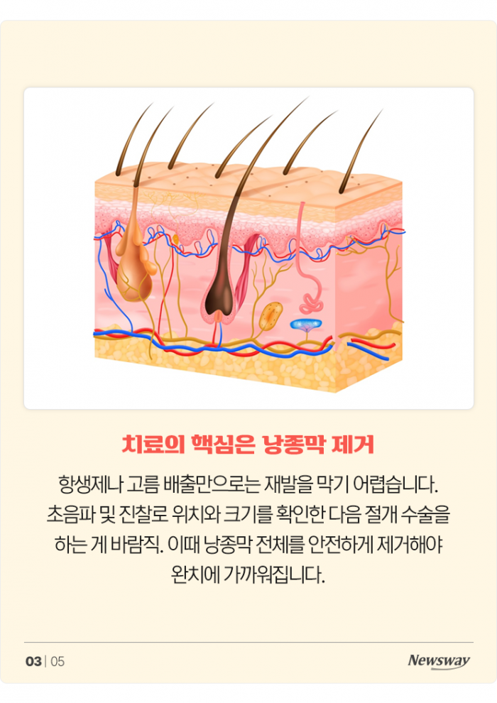 표피낭종, 여드름으로 착각 쉬운 피부 종양···재발·흉터 막으려면 정확한 진단과 치료 중요 기사의 사진