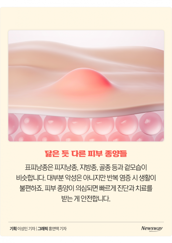 표피낭종, 여드름으로 착각 쉬운 피부 종양···재발·흉터 막으려면 정확한 진단과 치료 중요 기사의 사진