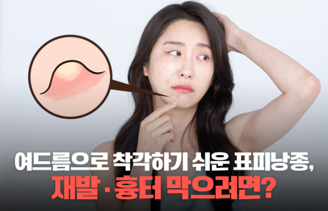 표피낭종, 여드름으로 착각 쉬운 피부 종양···재발·흉터 막으려면 정확한 진단과 치료 중요