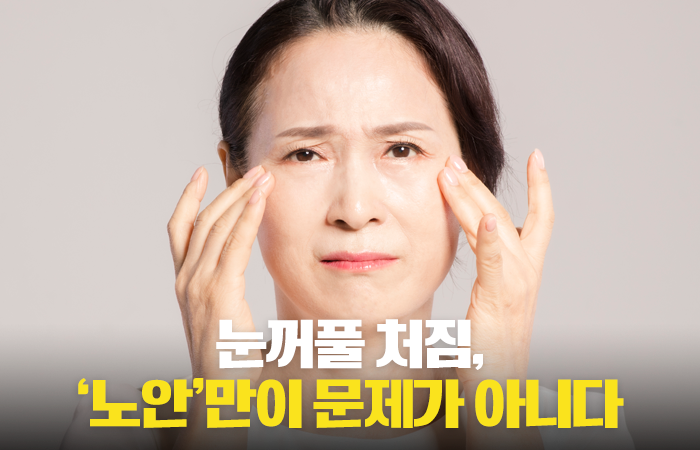 노화로 인한 눈처짐, 단순한 미용 문제로만 보기 어려워 기사의 사진