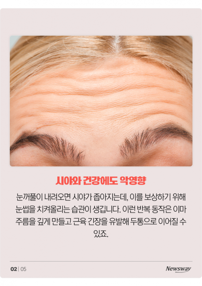 노화로 인한 눈처짐, 단순한 미용 문제로만 보기 어려워 기사의 사진