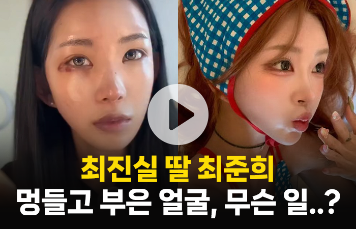 최진실 딸 최준희의 멍들고 부은 얼굴, 무슨 일이길래..? 기사의 사진
